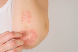 Los desafíos de vivir con enfermedad psoriásica se extienden mucho más allá de las lesiones cutáneas