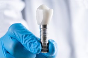 Los implantes dentales son cada vez más populares para reemplazos unitarios de dientes debido a su estética superior frente a opciones tradicionales como los puentes.