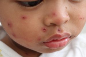 Autoridades sanitarias refuerzan medidas ante brote de sarampión en Texas