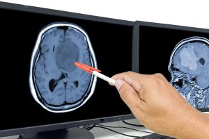 Vaximm AG presenta datos prometedores de un ensayo clínico fase 2a que evalúa la combinación de la vacuna oral VXM01 con avelumab para tratar el glioblastoma recurrente.