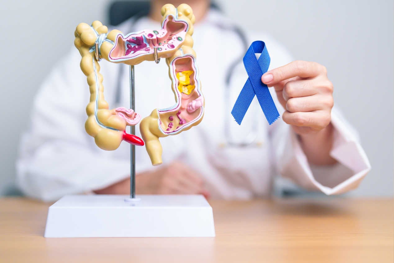 Nueva prueba casera de ARN podría prevenir el cáncer colorrectal antes de los síntomas
