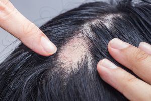 Nuevo tratamiento oral ofrece alternativa para adultos con alopecia areata severa en EE. UU.