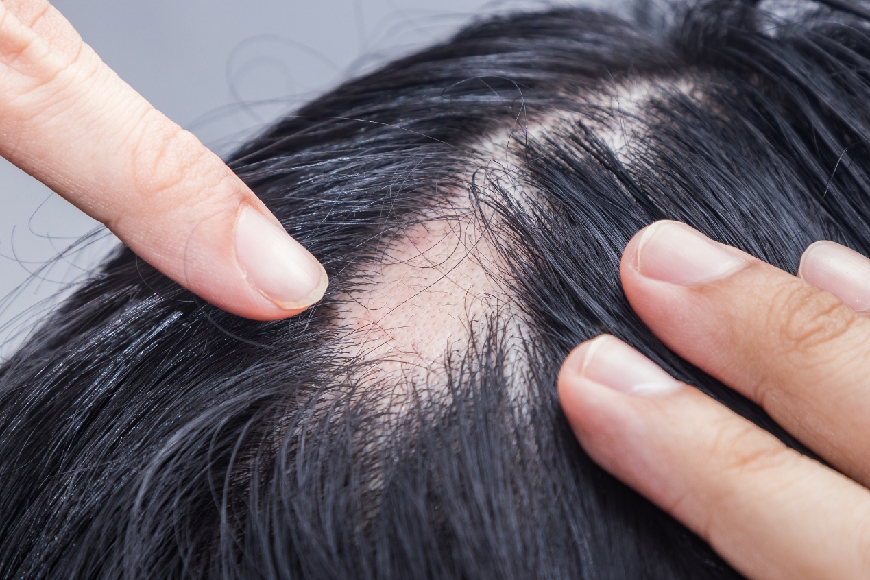 Nuevo tratamiento oral ofrece alternativa para adultos con alopecia areata severa en EE. UU.