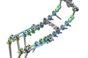 Nuevo sistema quirúrgico busca mejorar la estabilización de la columna cervical y torácica